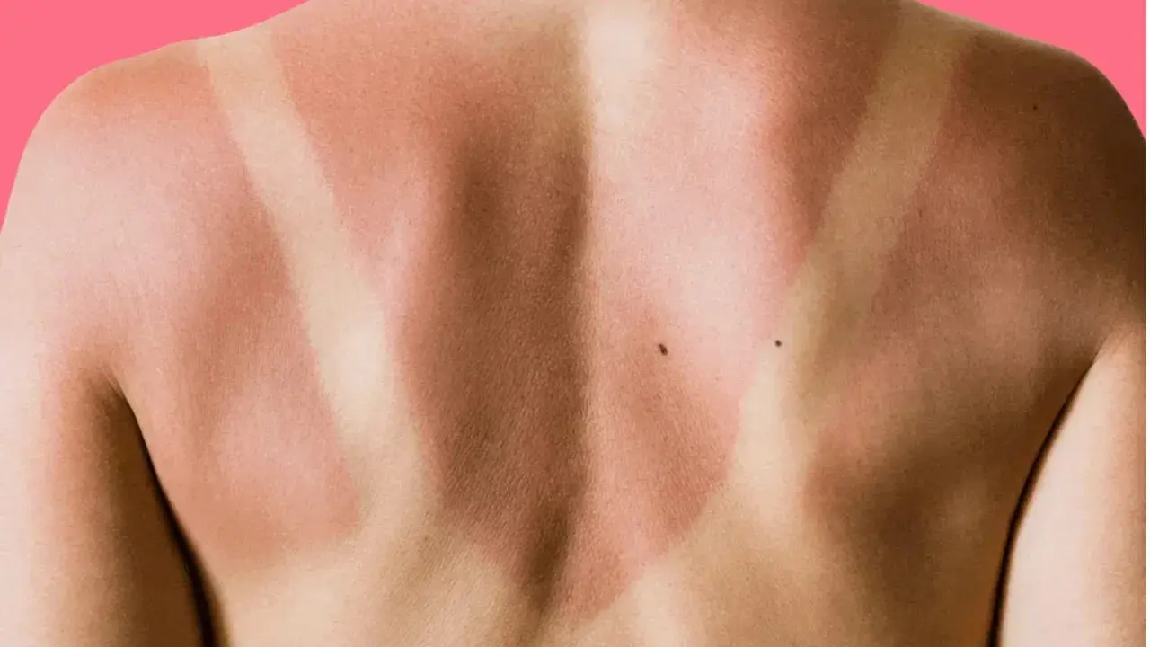 Schiena con evidente abbronzatura a strisce, segno di una giornata al sole con indumenti che hanno lasciato la pelle scoperta in alcune zone.