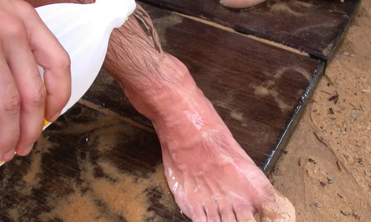 Piede bagnato sulla sabbia, con liquido versato da una bottiglia. Forse un rimedio dopo un incontro con una medusa Chrysaora hysoscella.