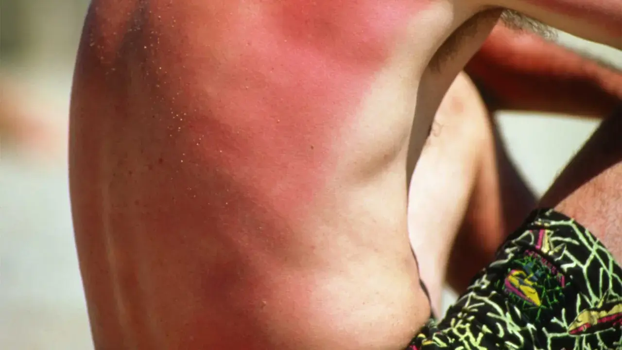 Schiena con forte abbronzatura rossa, segno di un'eccessiva esposizione al sole.