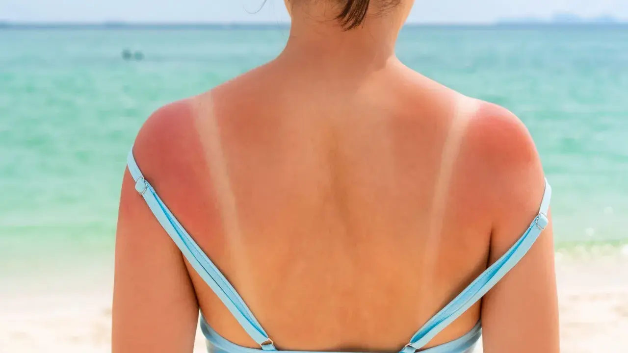 Spalle arrossate dal sole, con segni evidenti del costume. Una **pelle che non si abbronza** facilmente, ma che si scotta.