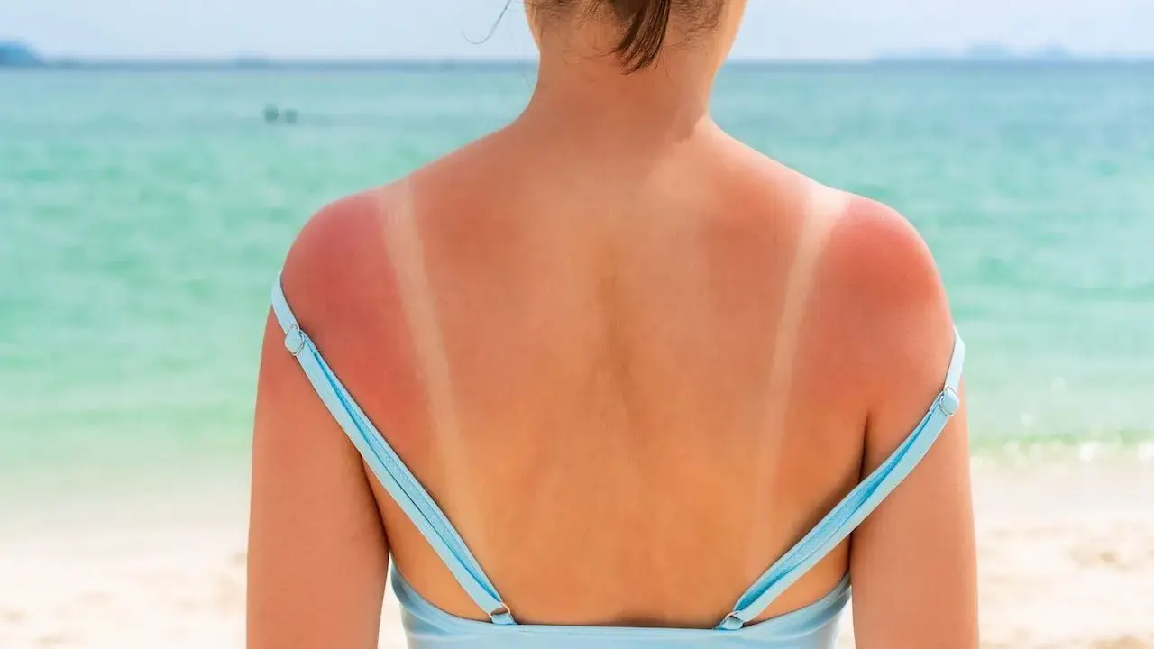 Spalle arrossate dal sole, segno che il sole abbronza fino a tardi. La pelle è irritata dove il costume ha protetto.