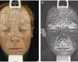 Confronto tra pelle senza crema solare (A) e pelle esposta a luce UV (B), evidenziando i danni solari.