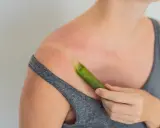 Spalla arrossata dal sole, con una foglia di aloe vera che lenisce le scottature.