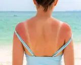 Spalle arrossate dal sole, con segni evidenti del costume. Una **pelle che non si abbronza** facilmente, ma che si scotta.