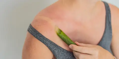 Spalla arrossata dal sole, con una foglia di aloe vera che lenisce le scottature.