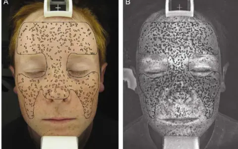 Confronto tra pelle senza crema solare (A) e pelle esposta a luce UV (B), evidenziando i danni solari.