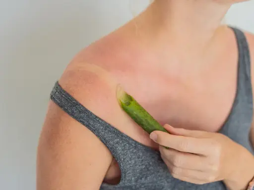 Spalla arrossata dal sole, con una foglia di aloe vera che lenisce le scottature.