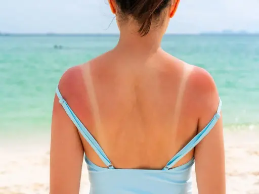 Spalle arrossate dal sole, segno che il sole abbronza fino a tardi. La pelle è irritata dove il costume ha protetto.