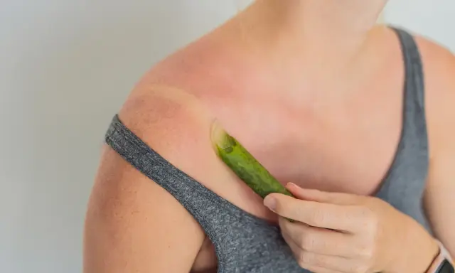 Spalla arrossata dal sole, con una foglia di aloe vera che lenisce le scottature.