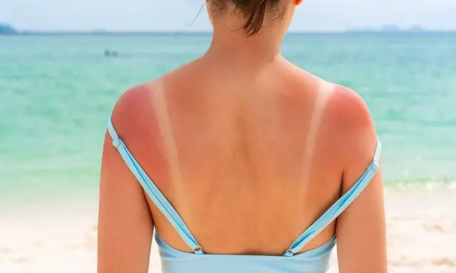 Spalle arrossate dal sole, segno che il sole abbronza fino a tardi. La pelle è irritata dove il costume ha protetto.