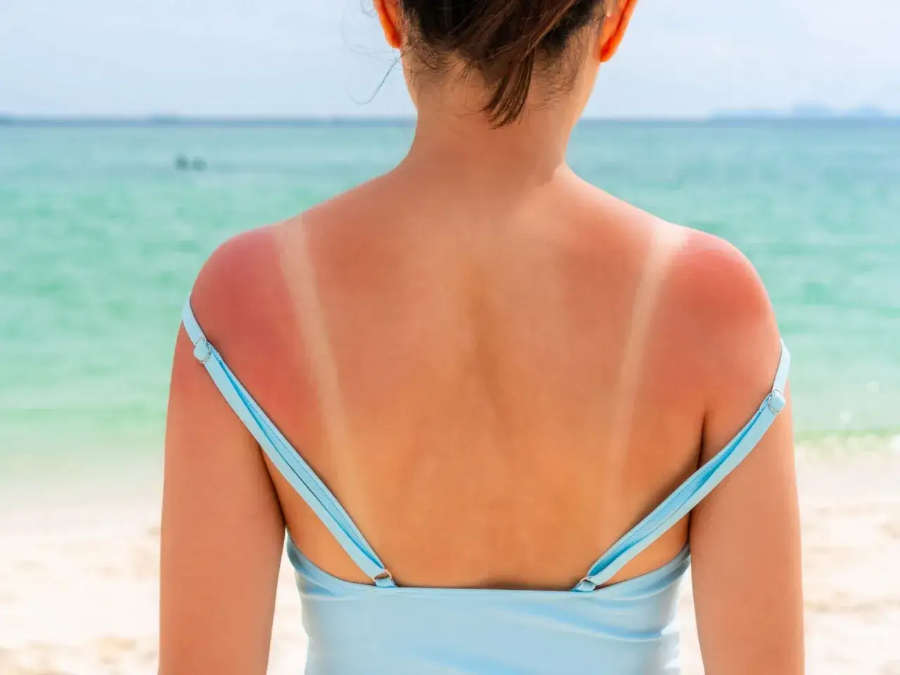 Spalle arrossate dal sole, con segni evidenti di scottatura. Chiss&agrave; fino a che ora abbronza il sole in questo paradiso.