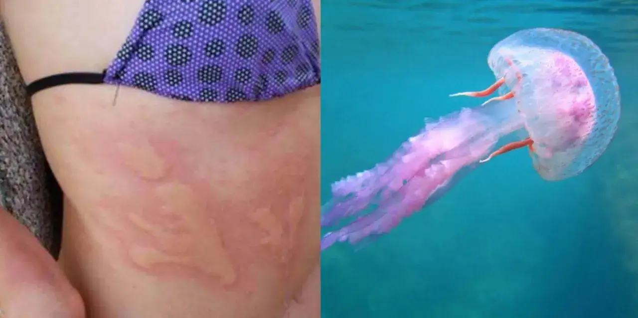 Reazione cutanea a una medusa velenosa. La medusa rosa e viola fluttua nell'acqua blu.