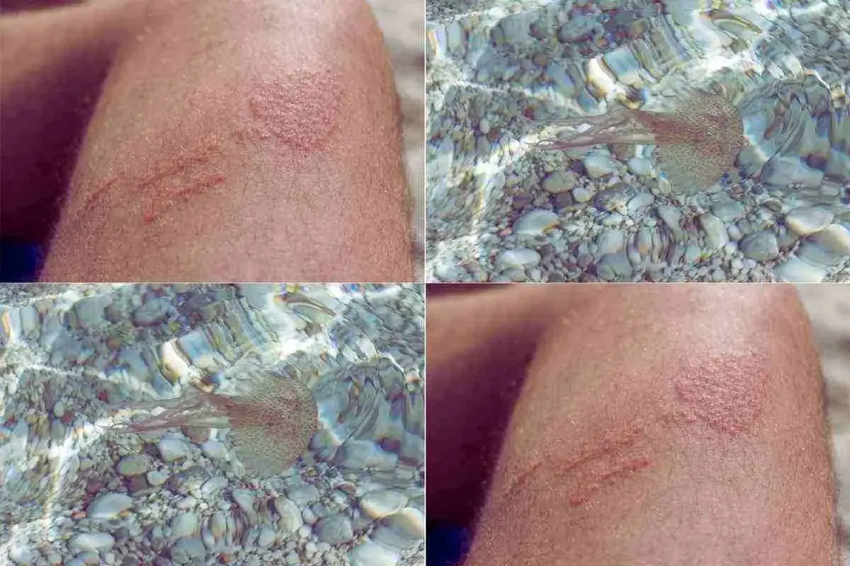 Punture di meduse quando ci sono. La pelle mostra irritazione e graffi, mentre sott'acqua si vedono le creature trasparenti.